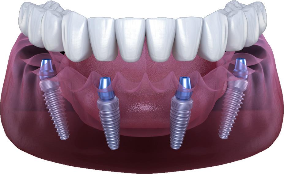 All-on-4-6 Dental Implants Treatment Miami Lakes, FL