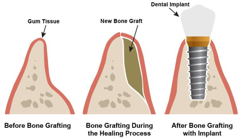 Ridge Augmentation Miami Lakes FL | Dental Implant Studio