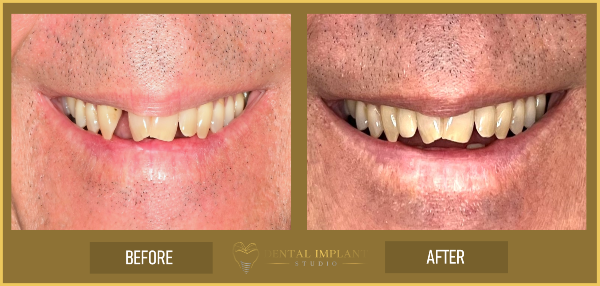 Dental Implants Miami Lakes Dental Implant Studio