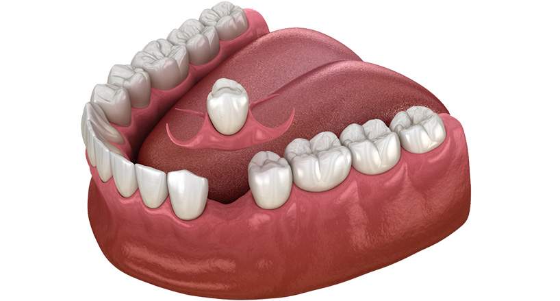 Single Tooth Replacement – Dental Implant Studio