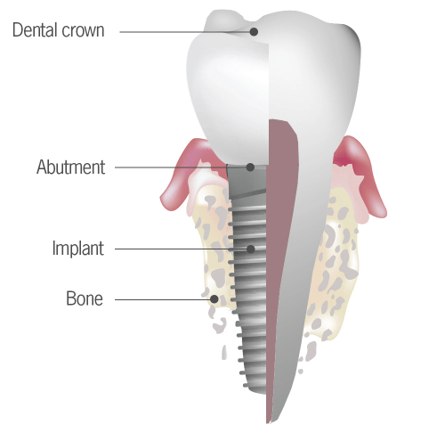 tooth implant illustration